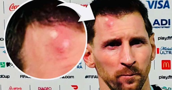 SC88 đổi thưởng và khoảnh khắc Messi sưng trán sau chiến thắng Cabo Verde - hình ảnh - sc88x.vip
